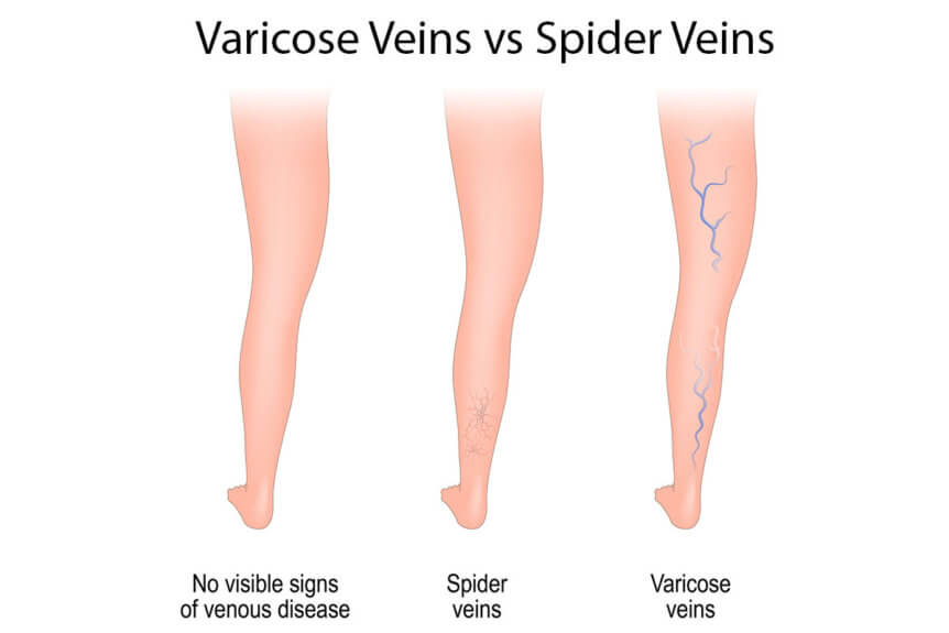 Varicose Veins vs Spider Veins