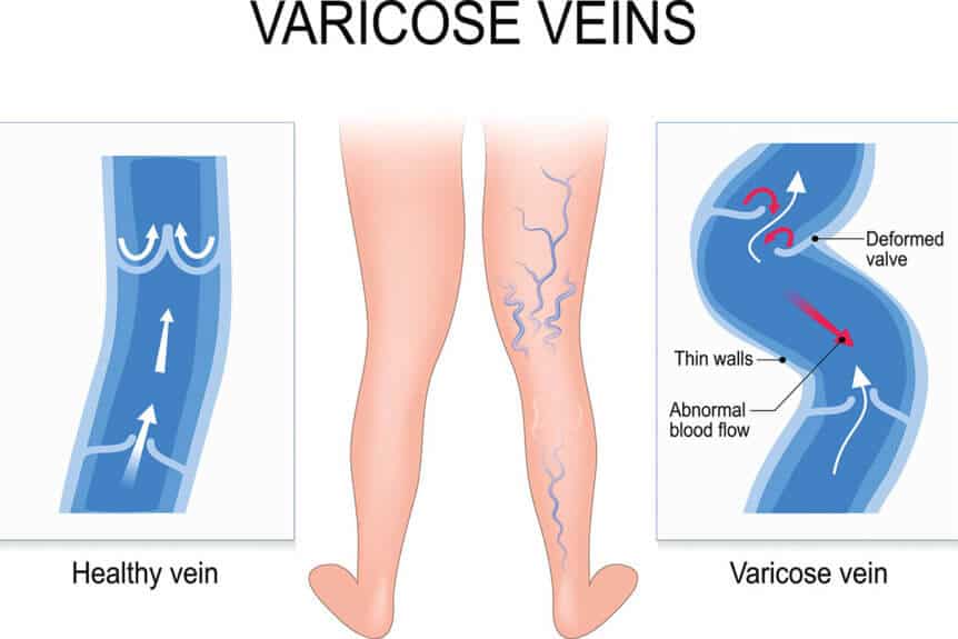 What You Need to Know About Varicose Veins